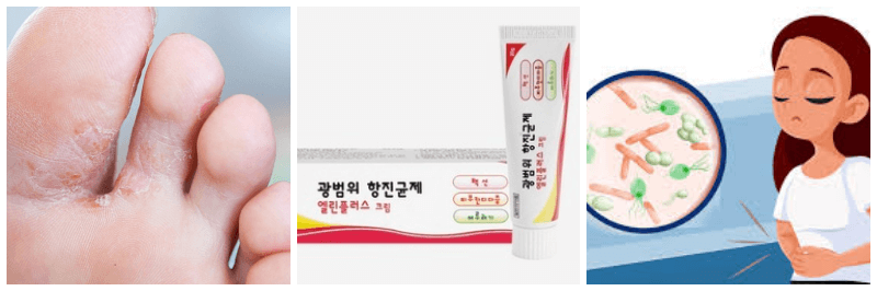 무좀, 엘린플러스크림, 세균성 질염 사진