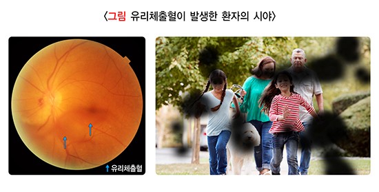 당뇨망막병증
