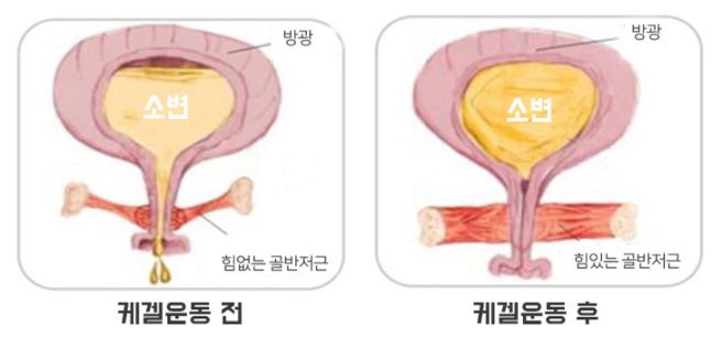 요실금 치료방법