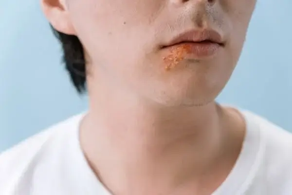 입 주변에 수포가 올라와 있는 사진