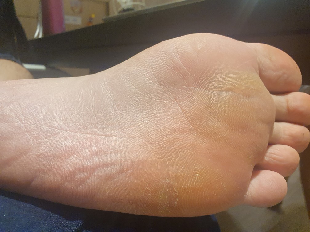 발바닥티눈사진