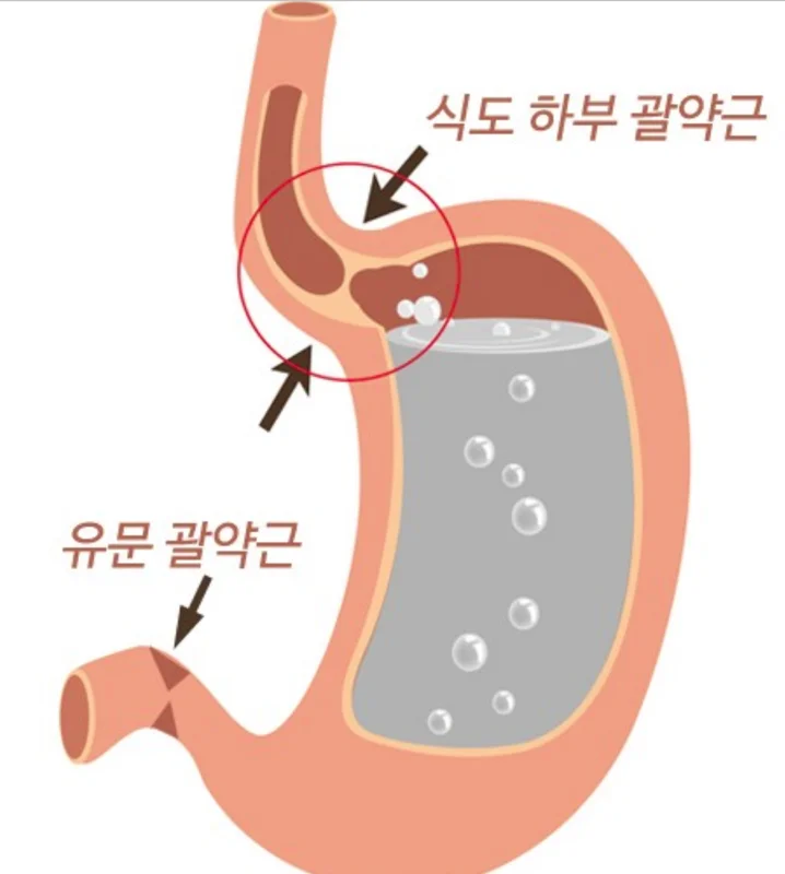 탄산수는 식도괄약근을 약화시킬 수 있습니다.