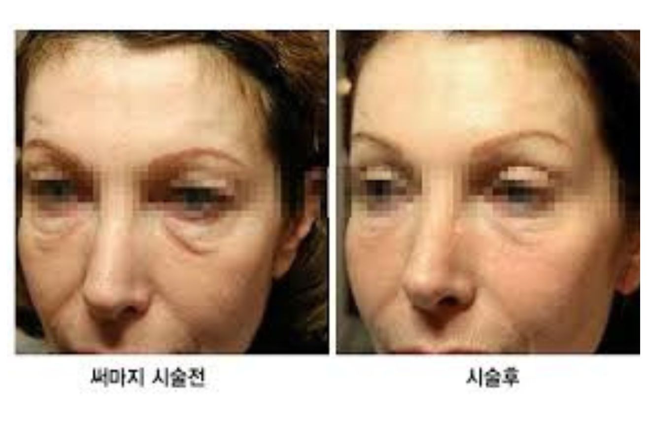 써마지 시술 전 후