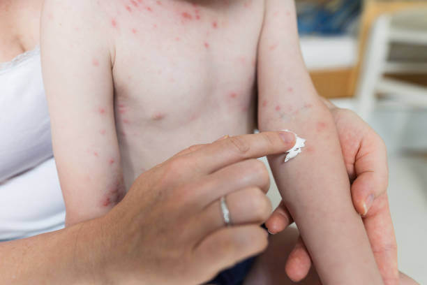 대상포진 예방접종 가격