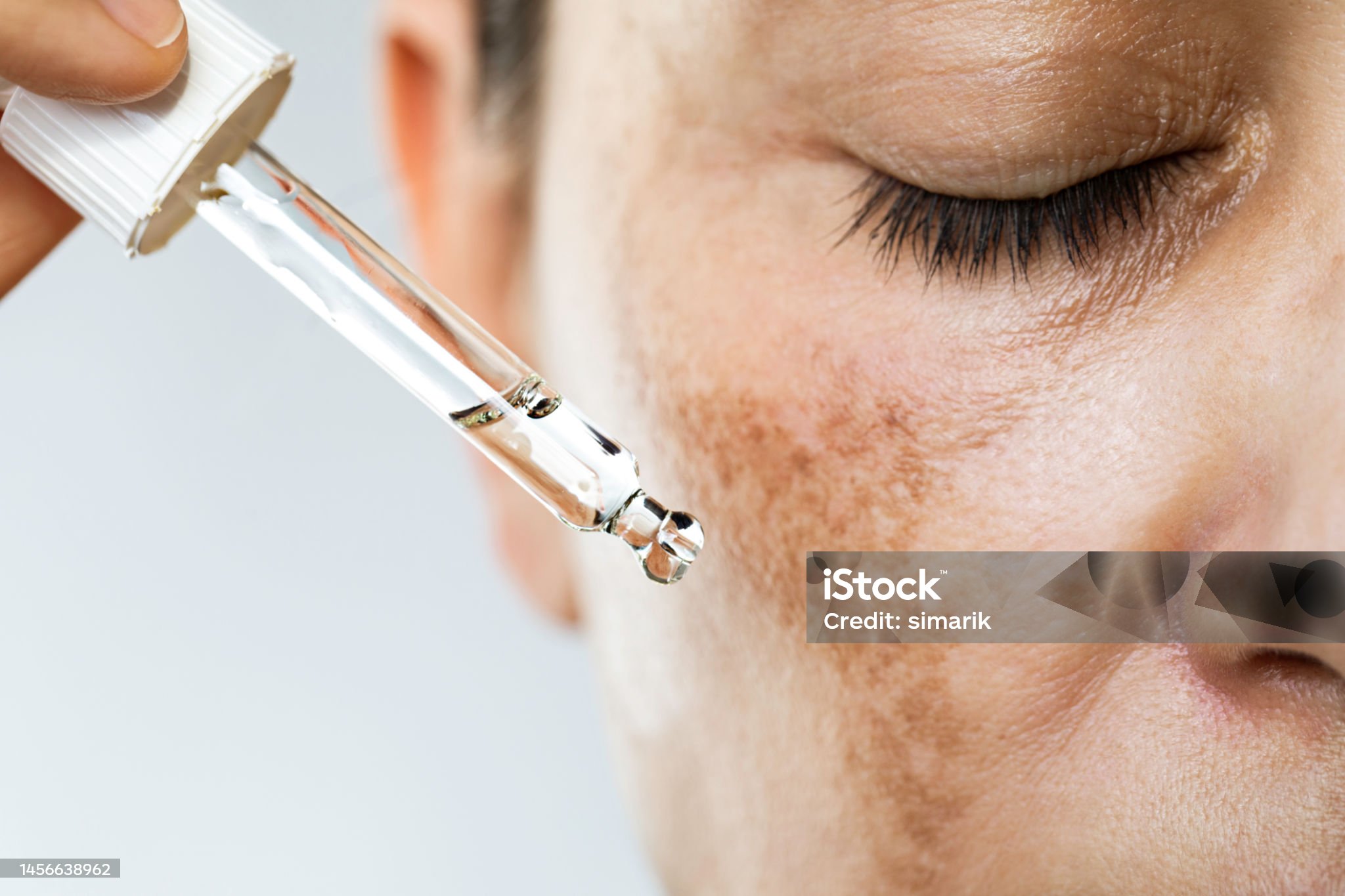 기미는 난치병이다