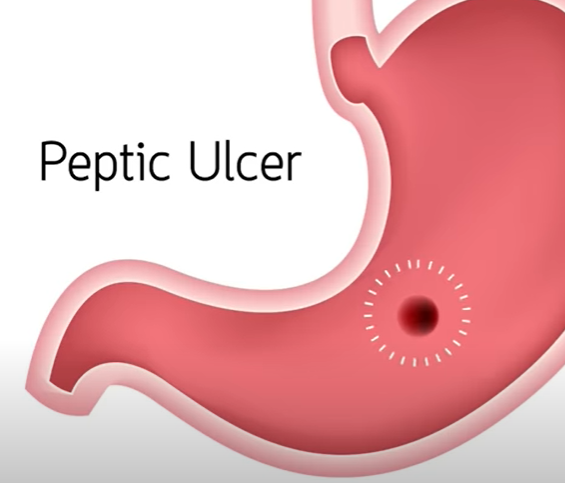 위궤양 이미지