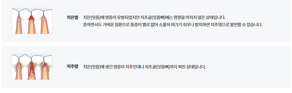 치주염/치은염