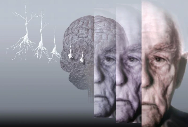 알츠하이머 발병 원인