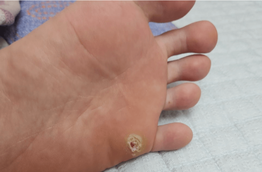 사마귀 완벽제거 방법&amp;#44;사마귀 생기는 이유&amp;#44;사마귀 종류 보통사마귀&amp;#44;사마귀 종류 편평사마귀&amp;#44;사마귀 종류 발바닥사마귀&amp;#44;사마귀 종류 성기사마귀&amp;#44;사마귀 종류 손발톱사마귀&amp;#44;집에서 사마귀 완벽제거하는 방법&amp;#44;집에서 사마귀 완벽제거하는 방법 살리실산 패치&amp;#44;집에서 사마귀 완벽제거하는 방법 살리실산 연고&amp;#44;사마귀연고 사용방법&amp;#44; 사마귀 완벽제거 방법 냉동치료&amp;#44; 사마귀 완벽제거 방법 레이저 치료&amp;#44;사마귀 완벽제거 방법 전기 소작법&amp;#44;사마귀 완벽제거 방법 수술적 제거&amp;#44; 사마귀 완벽제거 방법 면역치료&amp;#44; 사마귀 완벽제거 후 관리법&amp;#44; 사마귀 예방법&amp;#44;사마귀 예방법 손씻기&amp;#44;사마귀 예방법 발씻기&amp;#44; 사마귀 예방법공용물건사용 피하기&amp;#44; 사마귀 예방법 피부상처 관리&amp;#44; 사마귀 예방법 면연력 유지&amp;#44; 사마귀 예방법 성기 사마귀 예방&amp;#44; 성기사마귀 예방법 콘돔&amp;#44; 성기사마귀 예방법 HPV백신 접종&amp;#44; HPV 백신&amp;#44; 자궁경부암 예방