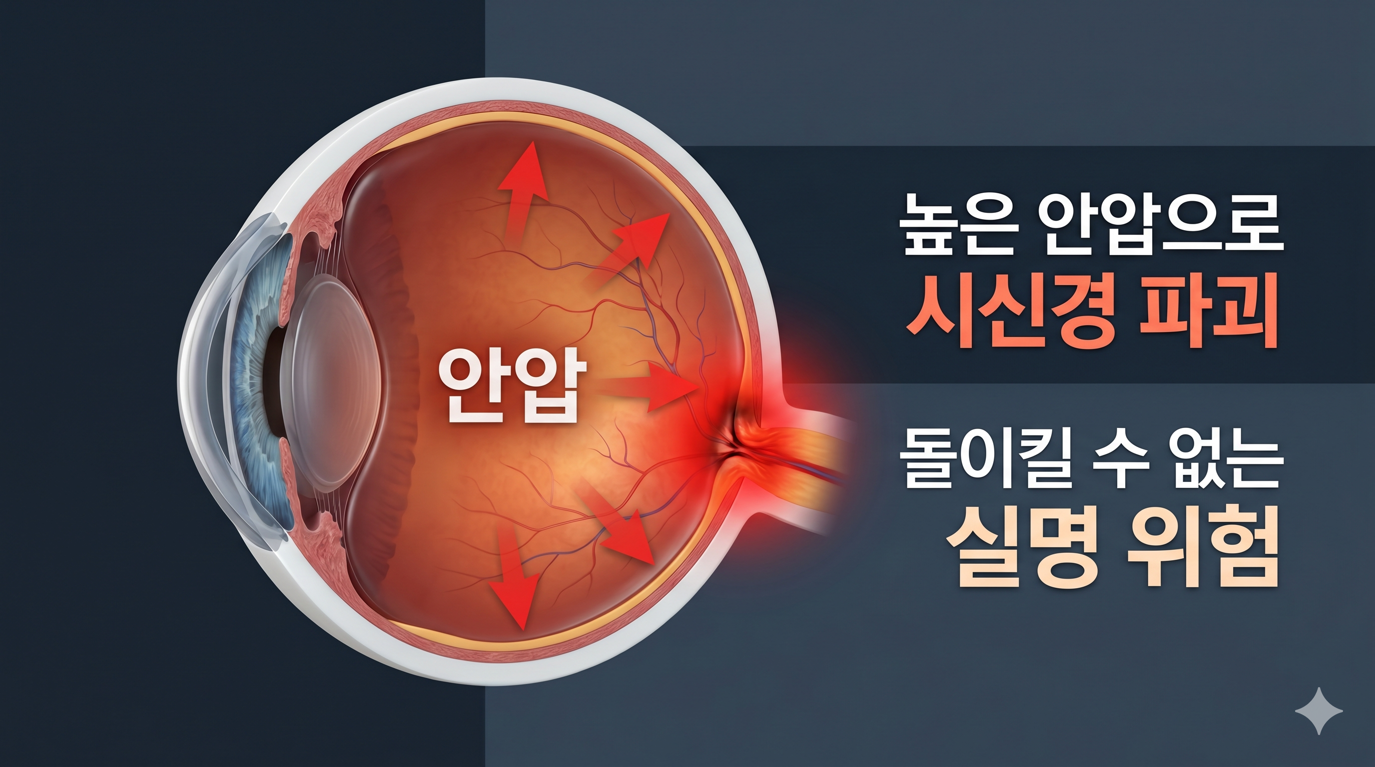 녹내장 초기증상, 안압 상승, 시신경 손상 - 눈 안의 액체(방수)가 빠져나가지 못해 압력이 높아지면서, 눈 뒤쪽의 굵은 시신경 다발을 물리적으로 짓눌러 붉게 손상시키는 3D 안구 해부도