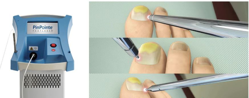 발톱 무좀 레이저 치료