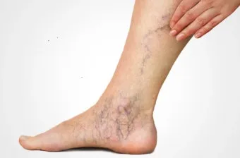 하지 정맥류 증상 치료방법과 예방 생활습관_4