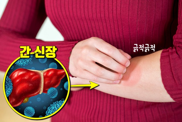 간이 안좋을때 증상,피부 가려움증,생로병사의비밀