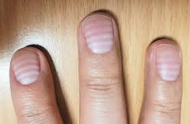 손톱과 당뇨병의 관계