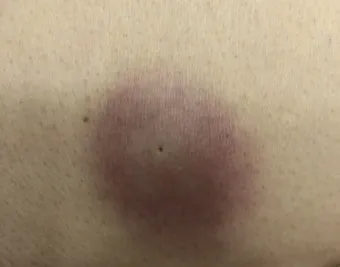 엉덩이 종기가 생기는 이유 왜 생기고 어떻게 관리할까요 완벽 가이드_10