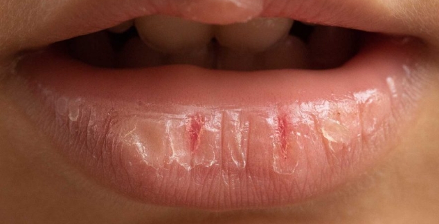 입술-각질-뜯기