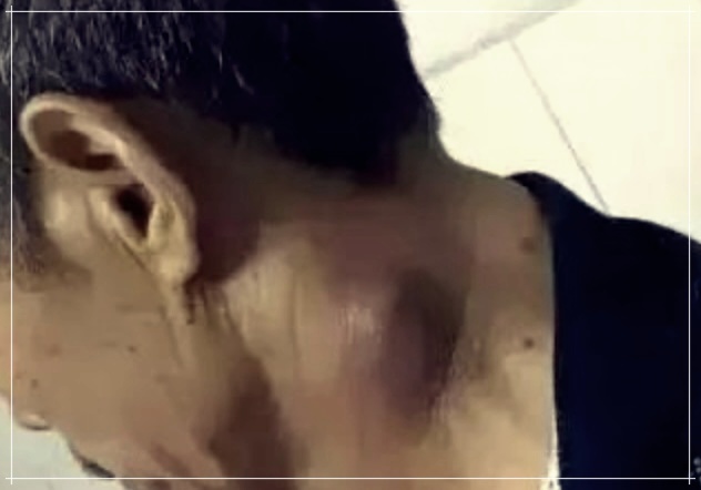 호지킨림프종과 비호지킨림프종: 이해&#44; 진단&#44; 그리고 치료