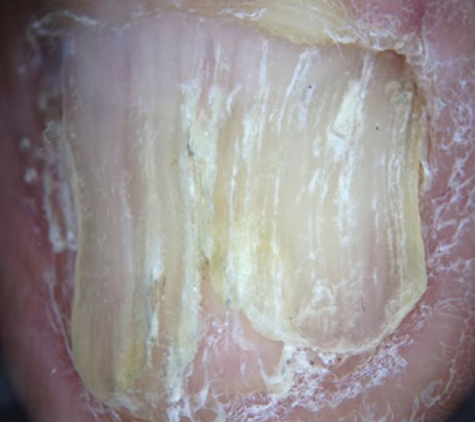 손톱이 잘 부러지는 이유