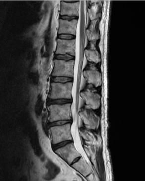 허리디스크 증상