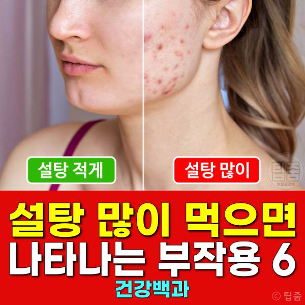 설탕 많이 먹으면 여드름 설탕부작용