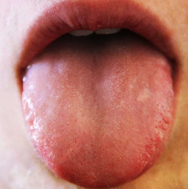 혓바늘이-돋아난-모습
