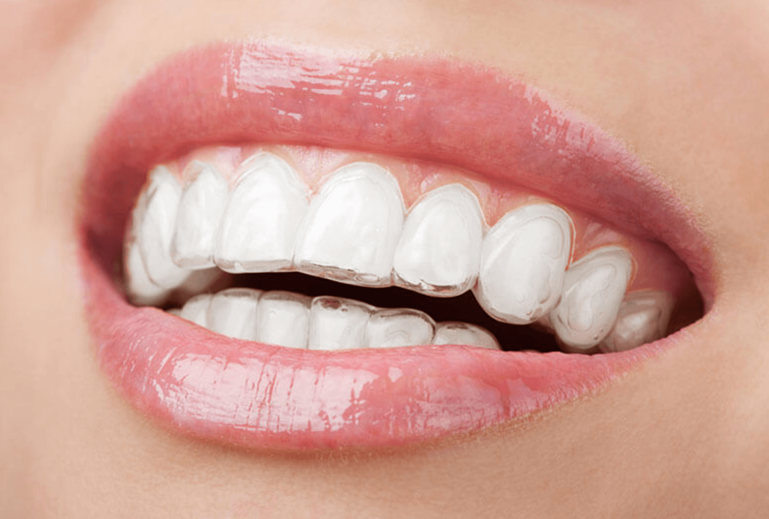 투명 교정기 기간