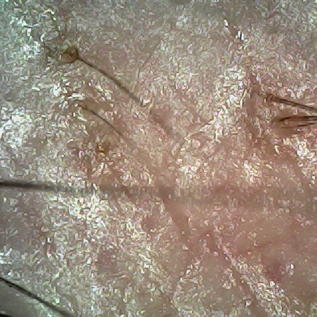 탈모 극복 프로젝트 - 오른쪽 M자 부위 두피 모습이다.