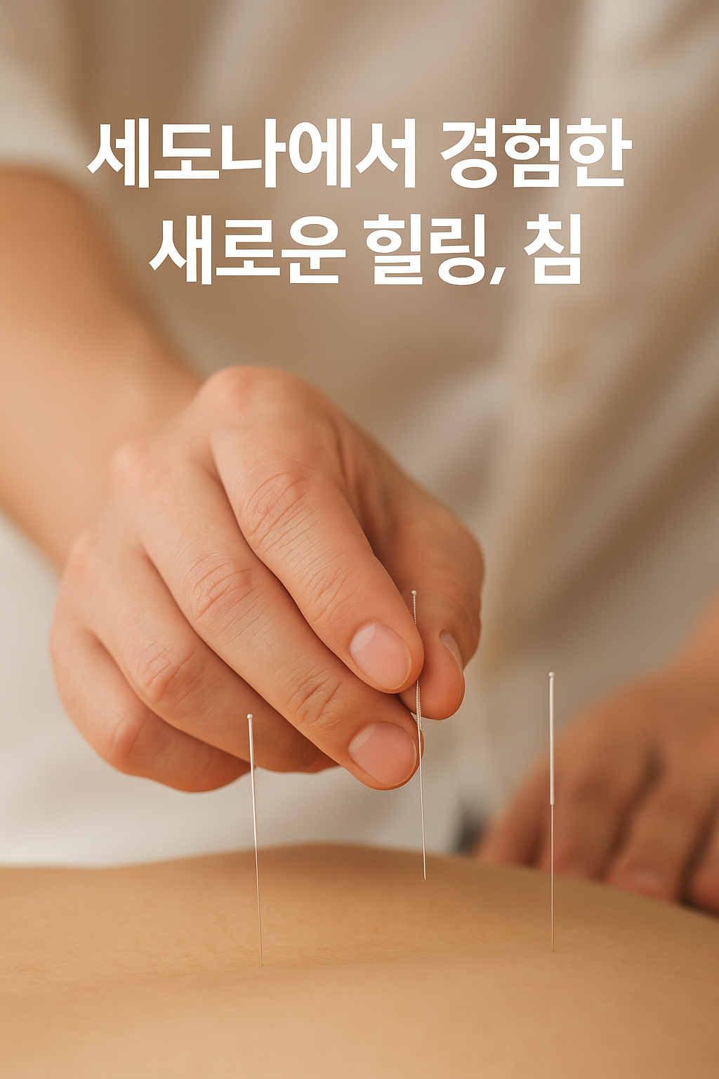 세도나에서 경험한 침 치료, 어깨에 침을 놓는 장면