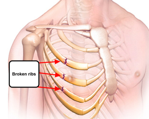 갈비뼈금간-사진2
