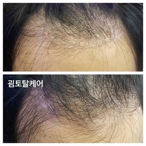 천안 탈모