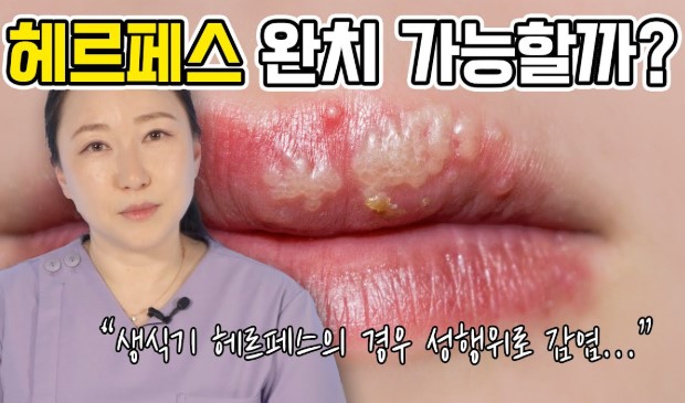 헤르페스바이러스