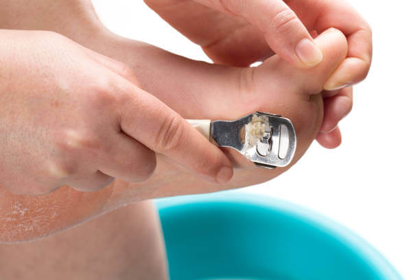 티눈 생기는 이유, 굳은살과 사마귀 차이 및 치료에 대해 알아봤습니다. 한번쯤은 손과 발에 티눈이 발생하는 것을 볼 수 있습니다. 티눈이 생기는 이유와 굳은살, 사마귀 차이점, 치료법, 티눈약 부작용 및 주의사항도 참고하시기 바랍니다.