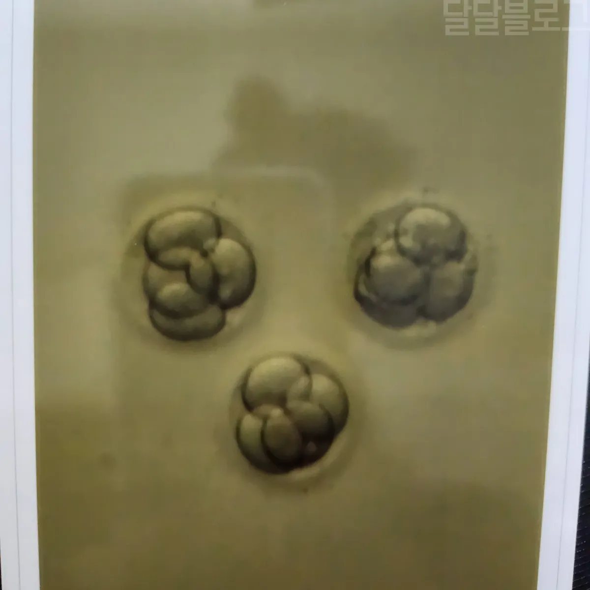 시험관-배아-이식-상급