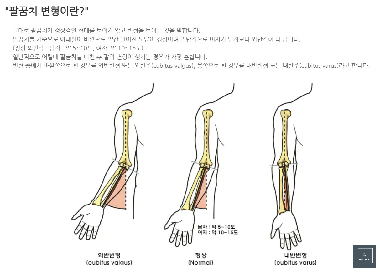 팔꿈치변형각