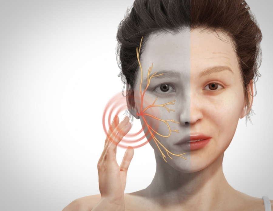 한 여성이 입이 왼쪽으로 돌아가는 안면신경마비, 즉 구안와사를 앓고 있으며, 얼굴에 3차 신경의 위치를 그린 이미지 사진