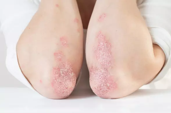건선