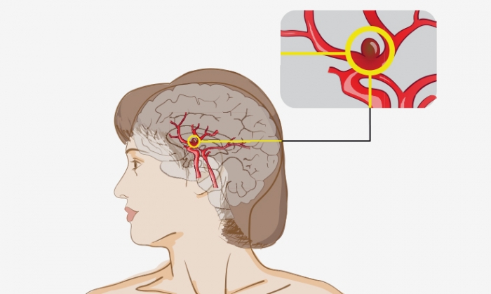 뇌동맥류 전조증상