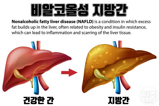 지방간 증상 비알코올성지방간
