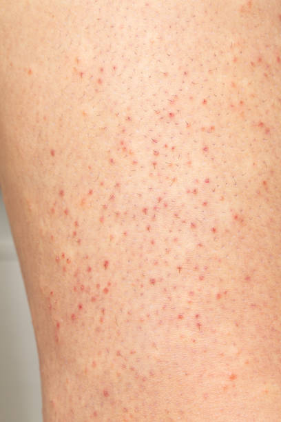 기미 흑자 관련 이미지