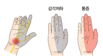 alt="손목 수근관 증후군"