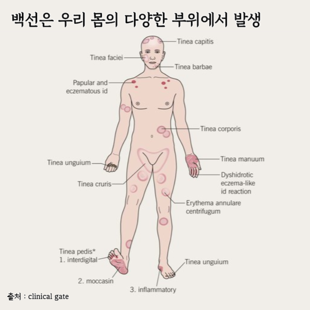 백선-치료
