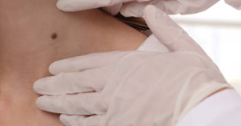 쥐젖 제거 방법 쥐젖 제거 연고 실비보험 비용 쥐젖 패치 종류