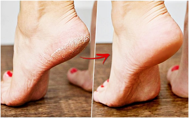 발뒤꿈치 각질제거 갈라짐,뒤꿈치 굳은살 제거,레몬껍질,풋크림