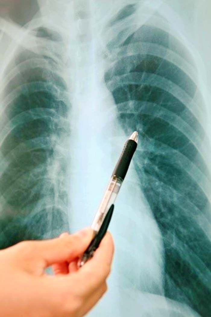 반드시 알아야 할 몸이 보내는 신호 폐암 초기 증상 8가지