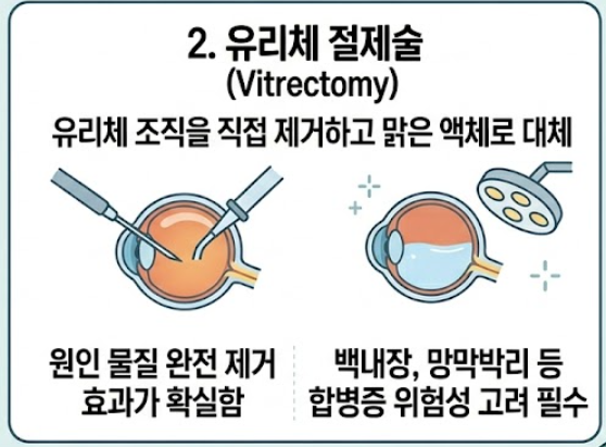 비문증 치료방법
