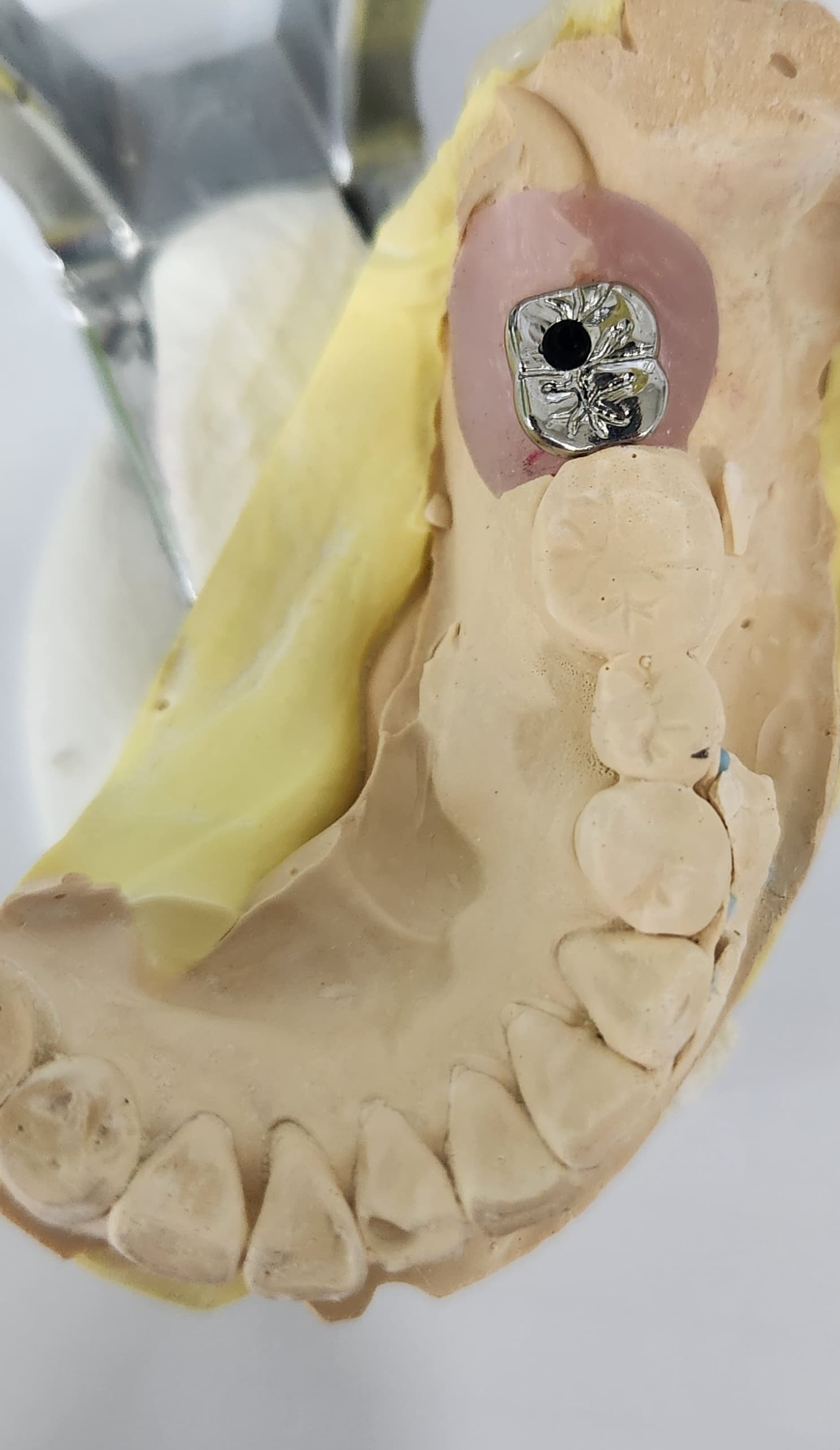 임플란트 크라운 종류