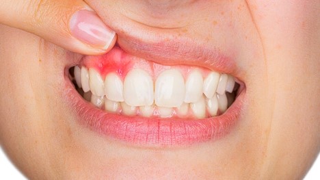 잇몸염증-치료방법