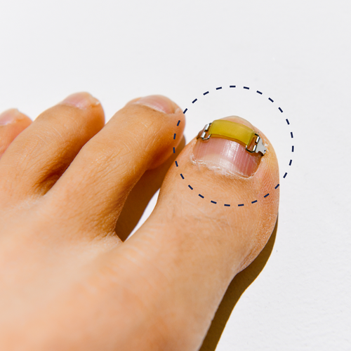 내성발톱 교정테이프 추천