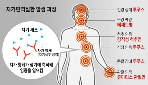 자가면역질환발생 과정