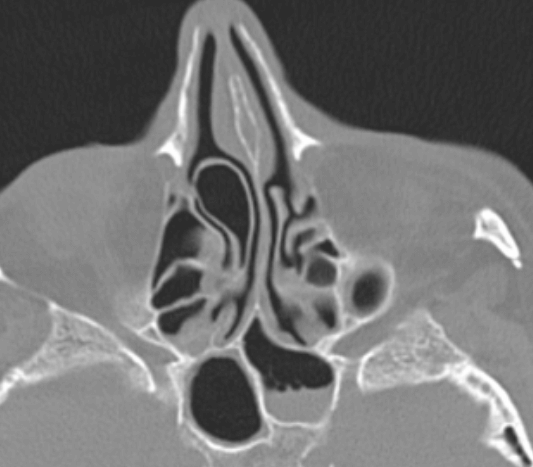 비중격만곡증-증상-치료-수술비용